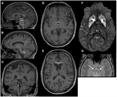 Magnetic resonance imaging modalities aid in the differential diagnosis of atypical parkinsonian syndromes